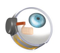 retine artificielle : implant dans l'oeil