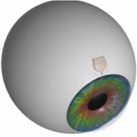 photo implant oculaire pour traiter un glaucome